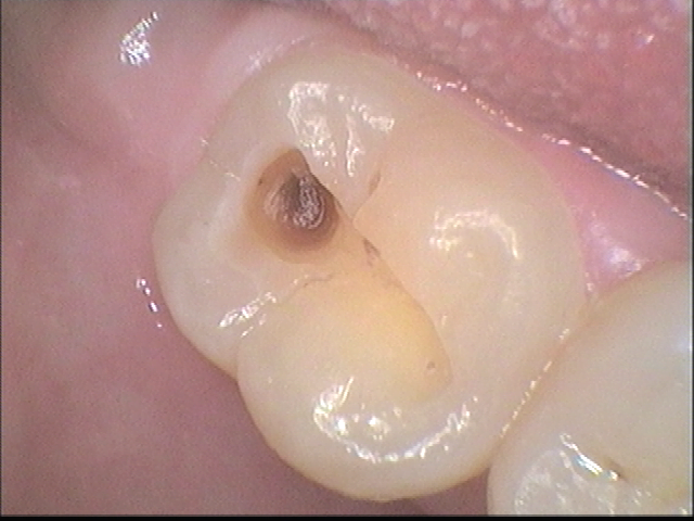 After White Fillings 2
