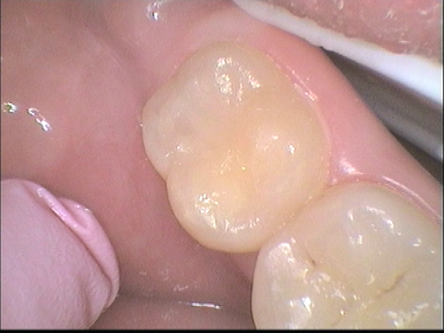 After White Fillings 2